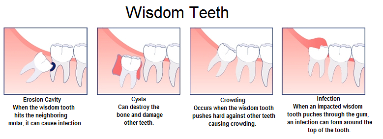 types of impacted wisdom teeth