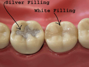 Bahamas Dental Care Tooth Fillings