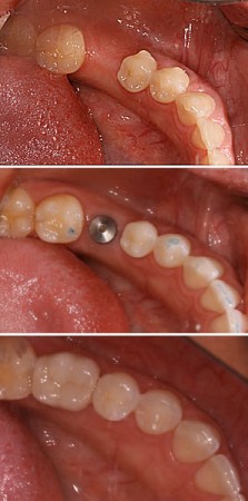 bahamas-dentistry-implants