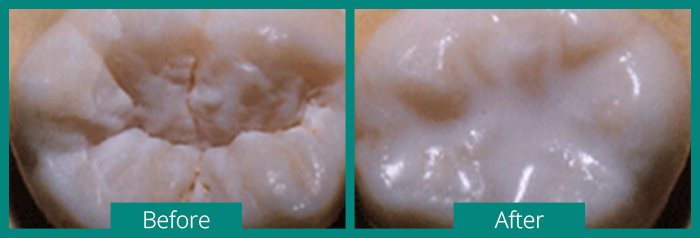 Dental Sealants