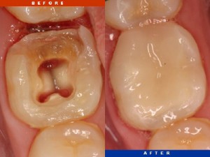 Bahamas Dental Care - Root Canal