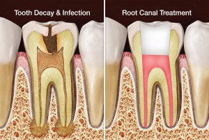 Bahamas Dental Care - Root Canal