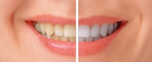 Bahamas Dental Care Teeth Bleaching