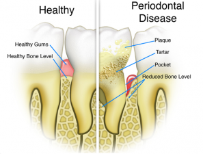 Periodontal Disease - Rainbow Dental Bahamas